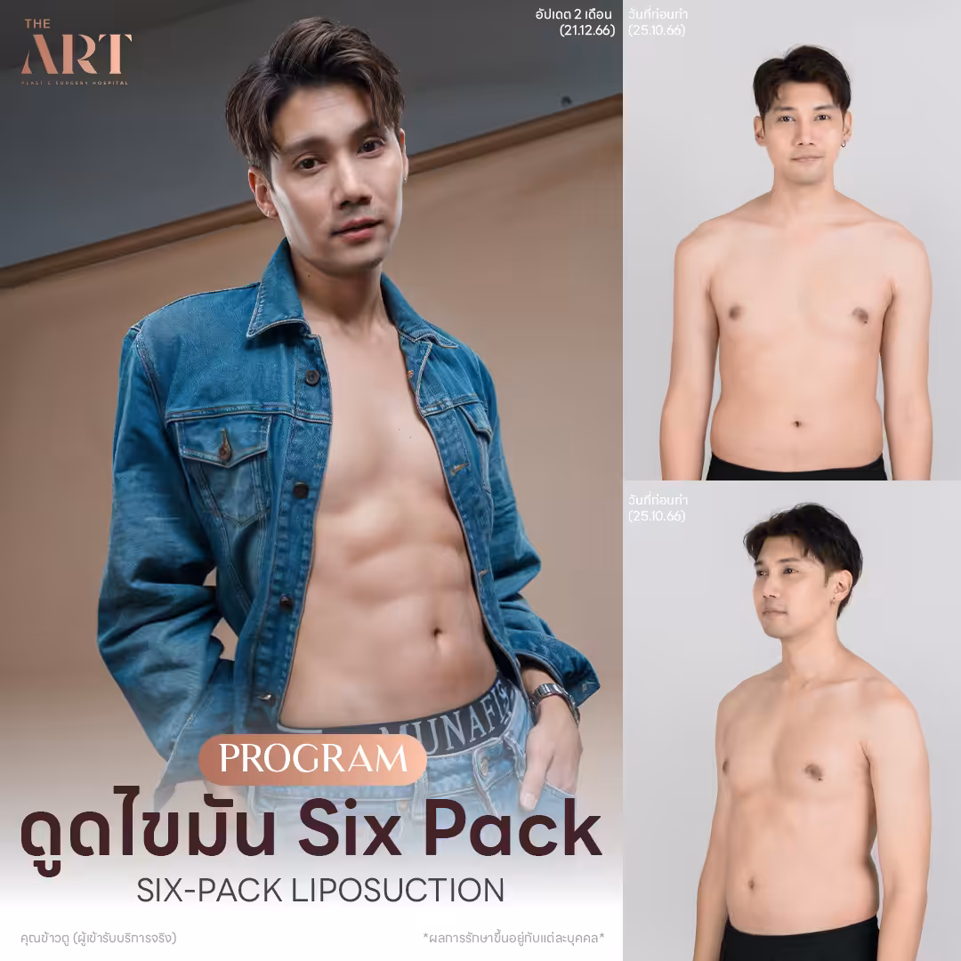 liposuction-sixpack-fashion-set-khun-khaotu.png