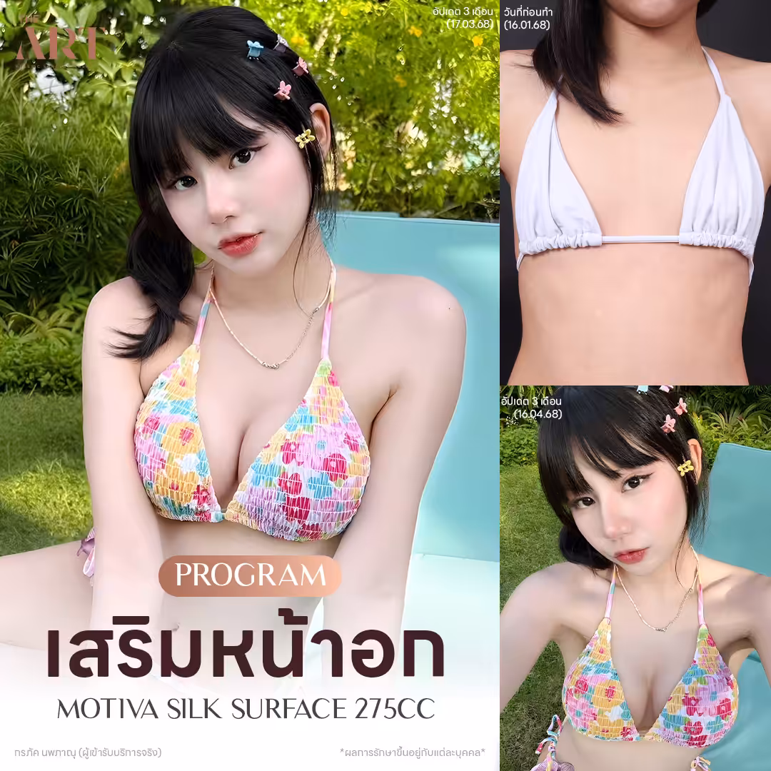 breast-augmentation-koraphak-nopphanu-MOTIVA-SILK-SURFACE-275CC.jpg