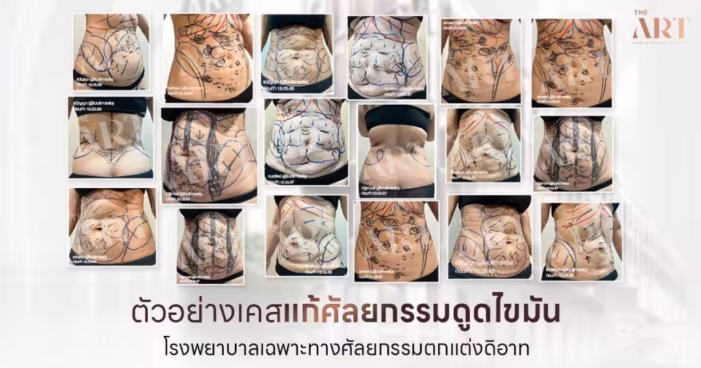 ตัวอย่างเคสดูดไขมัน-ก่อนหลัง