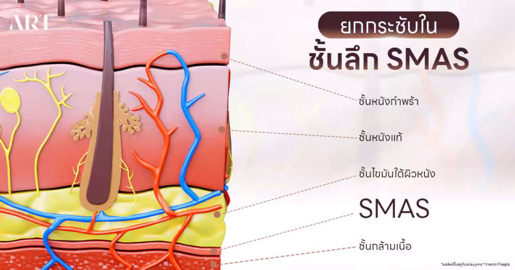 ดึงหน้า ยกกระชับผิวชั้นลึก SMAS